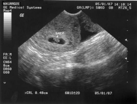 ultrasound2.jpg
